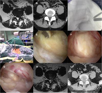 The clinical efficacy of biportal endoscopy is comparable to that of uniportal endoscopy via the interlaminar approach for the treatment of L5/S1 lumbar disc herniation